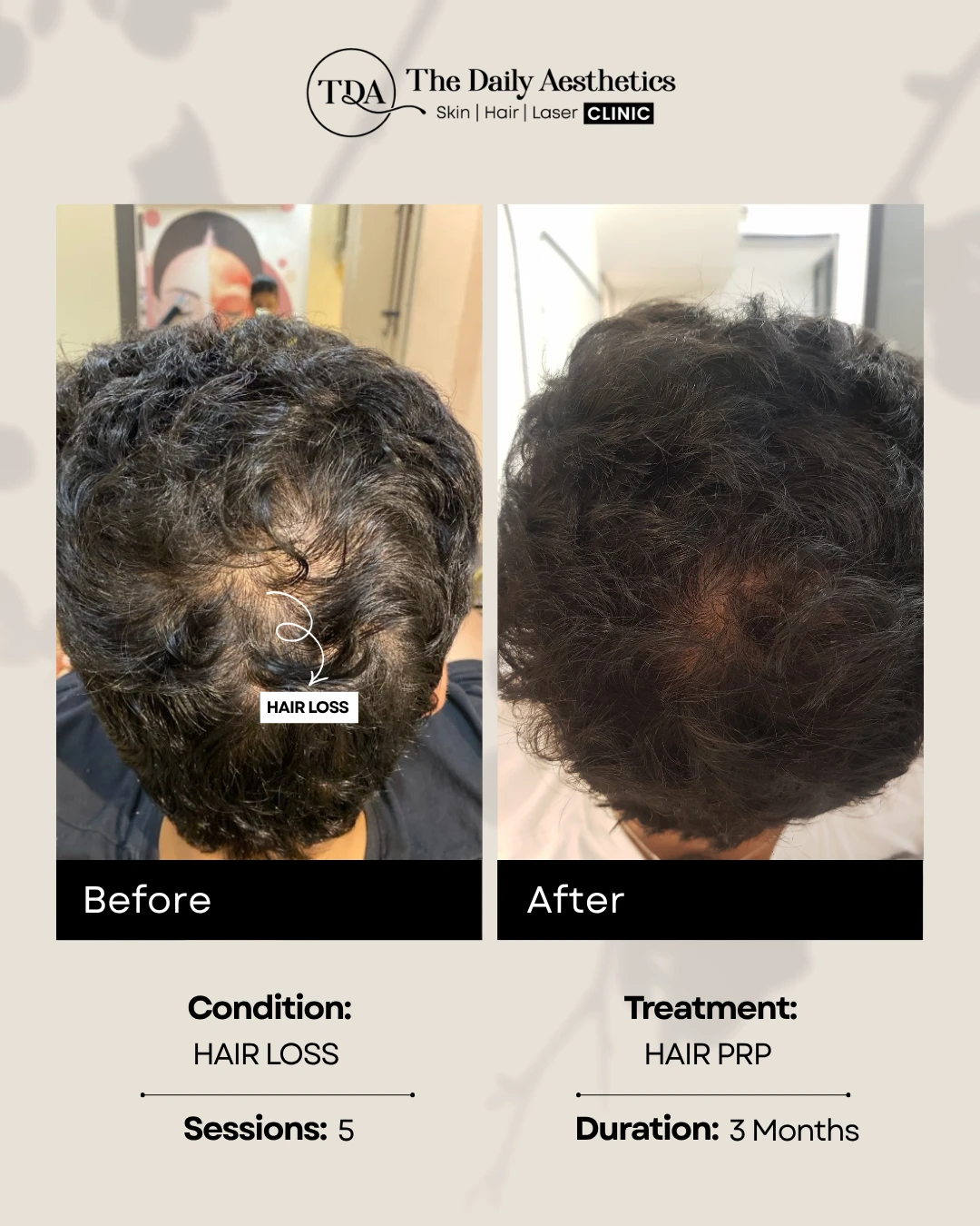 Hair Loss (Advance Hair PRP Treatment) (3)