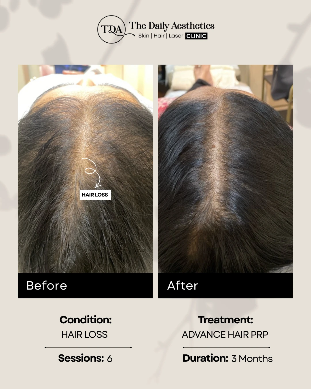 Hair Loss (Advance Hair PRP Treatment) (4)