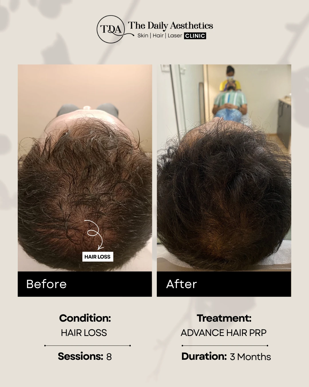 Hair Loss (Advance Hair PRP Treatment)