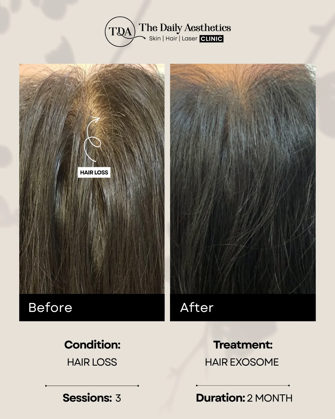 Hair Loss (Hair Exosome Treatment)