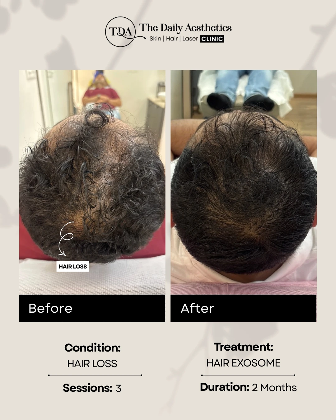 Hair Loss (Hair Exosome Treatment)
