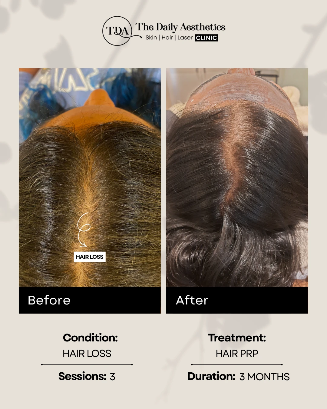 Hair Loss (Hair PRP Treatment)