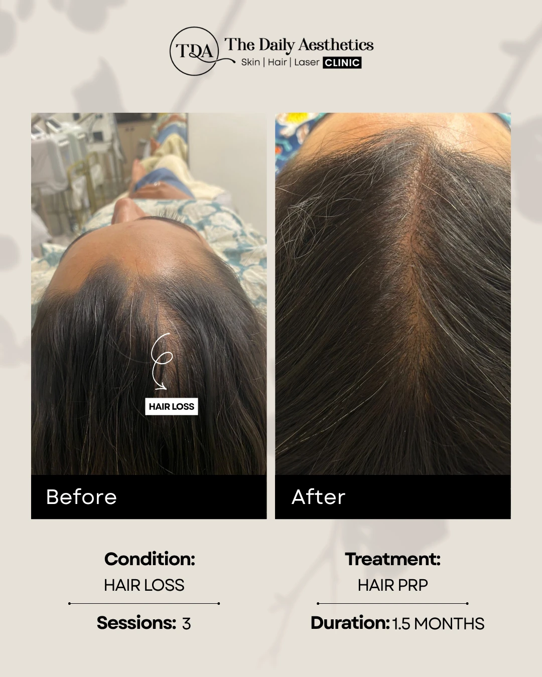 Hair Loss (Hair PRP Treatment) (2)