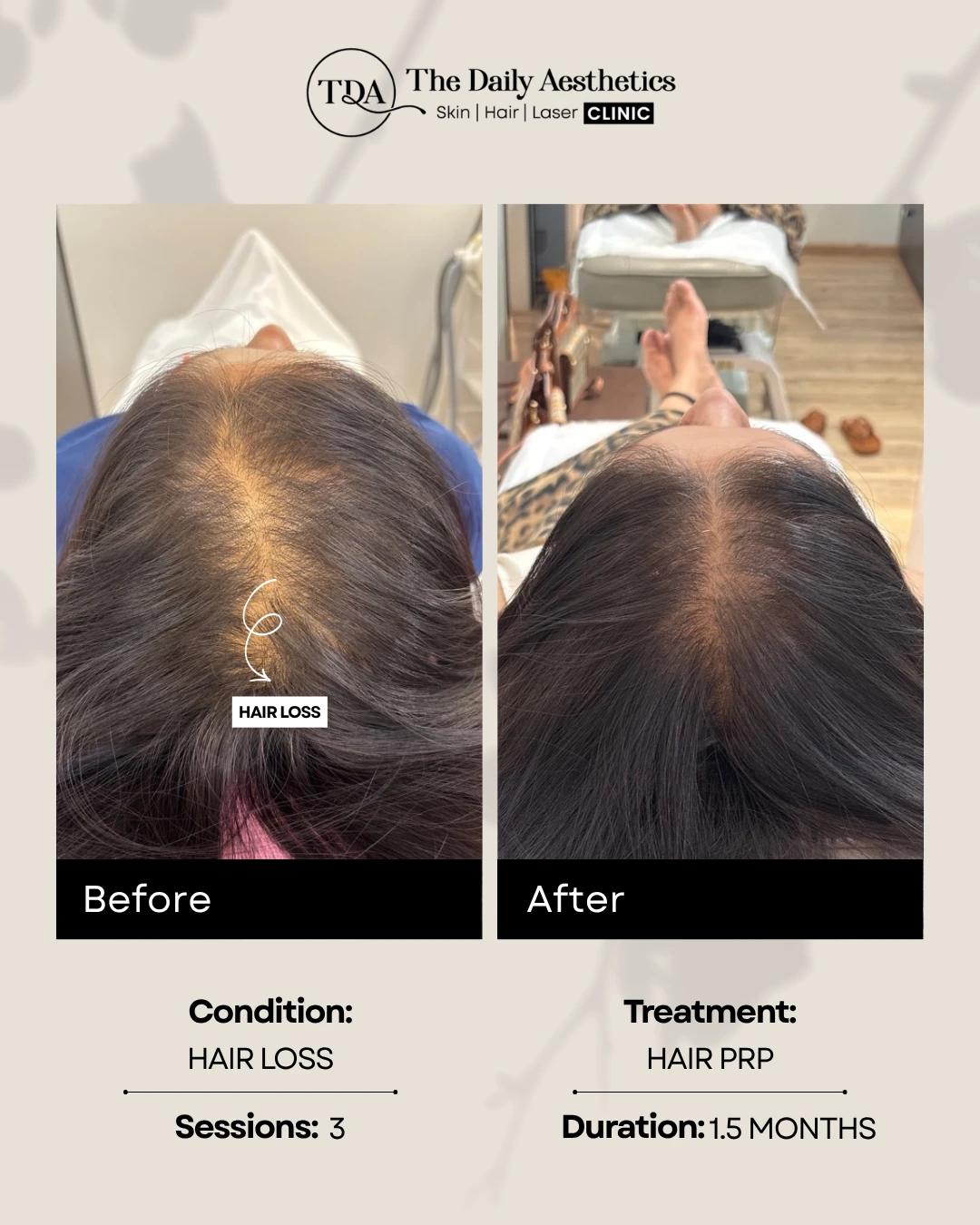Hair Loss (Hair PRP Treatment)