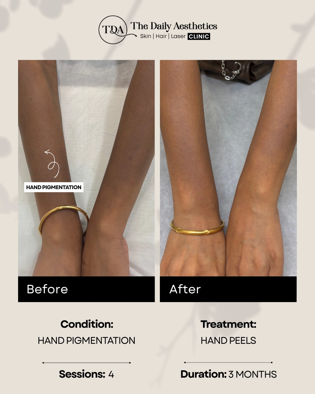 Hand Pigmentation (Hand Peels Treatment)