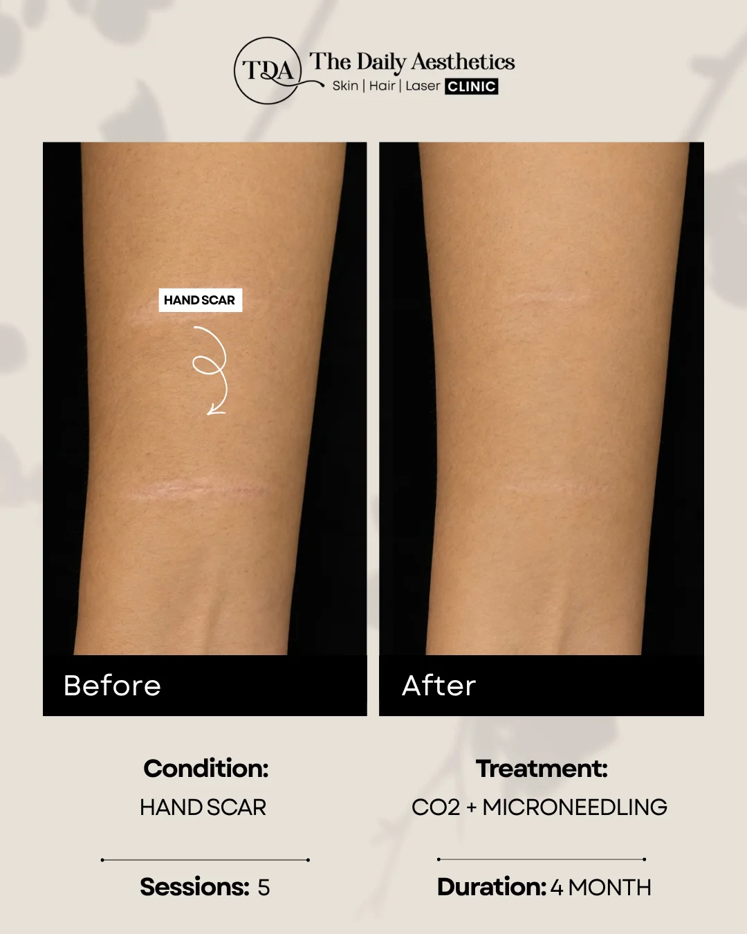 Hand Scar (CO2 + Microneeding Treatment)