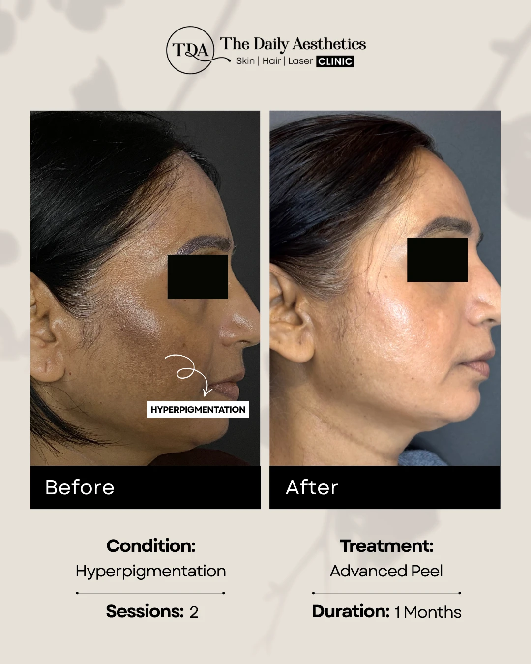 Hyperpigmentation (Advanced Peel Treatment) (2)