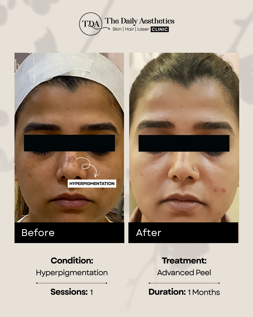 Hyperpigmentation (Advanced Peel Treatment)