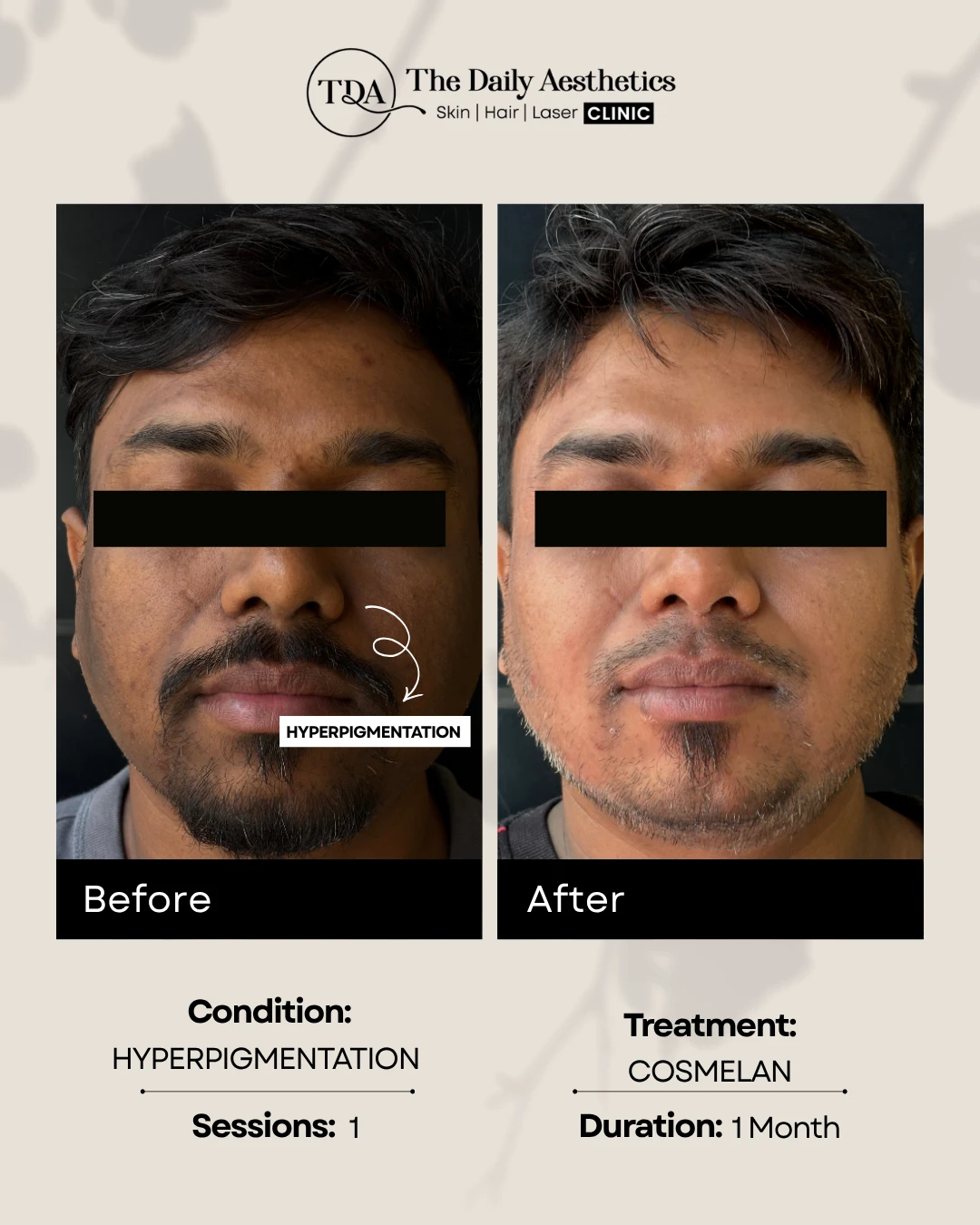 Hyperpigmentation (Cosmelan Treatment) (2)