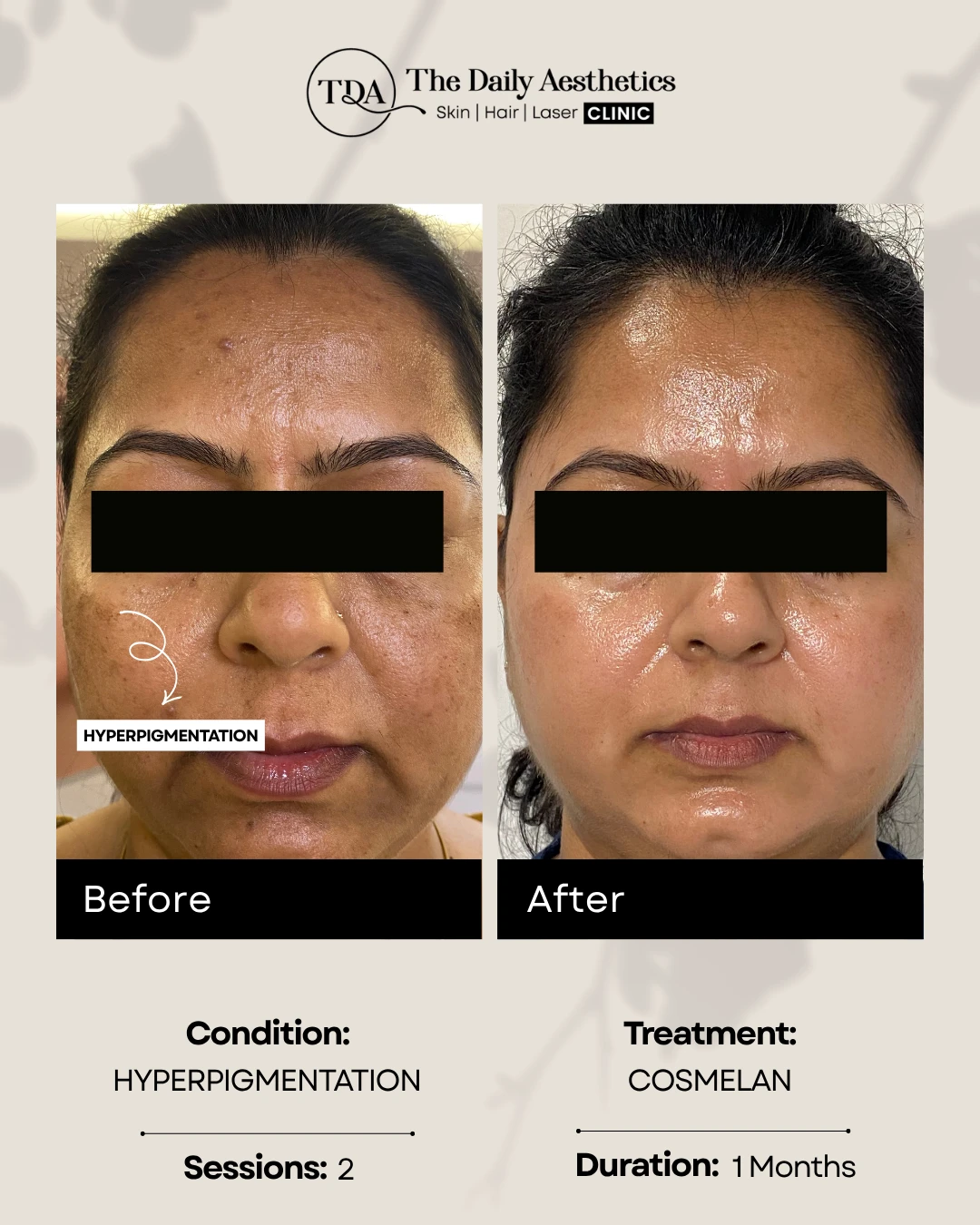 Hyperpigmentation (Cosmelan Treatment)