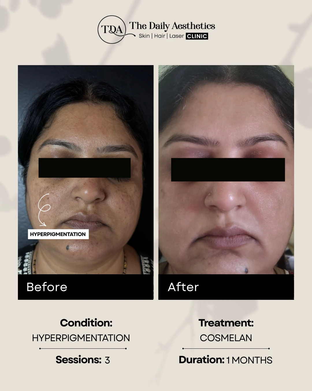 Hyperpigmentation (Cosmelan)