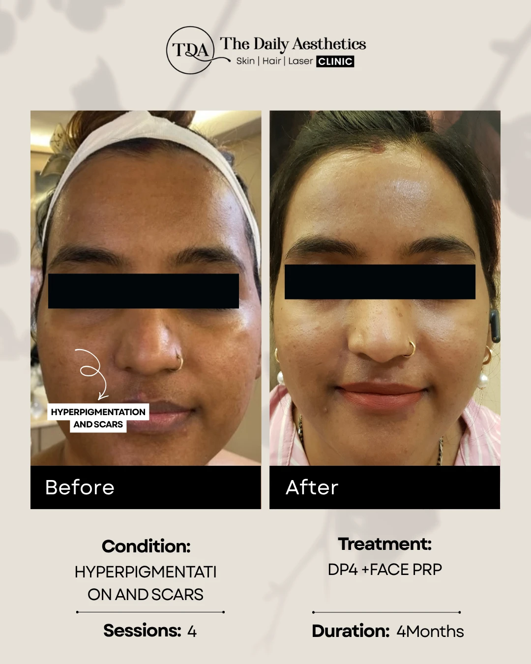 Hyperpigmentation and Scars (DP4 + Face PRP)