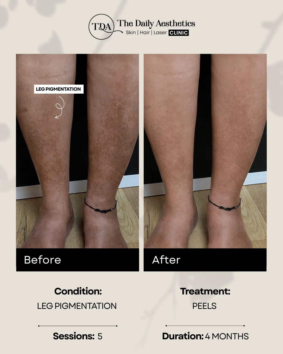 Leg Pigmentation (Peels Treatment)