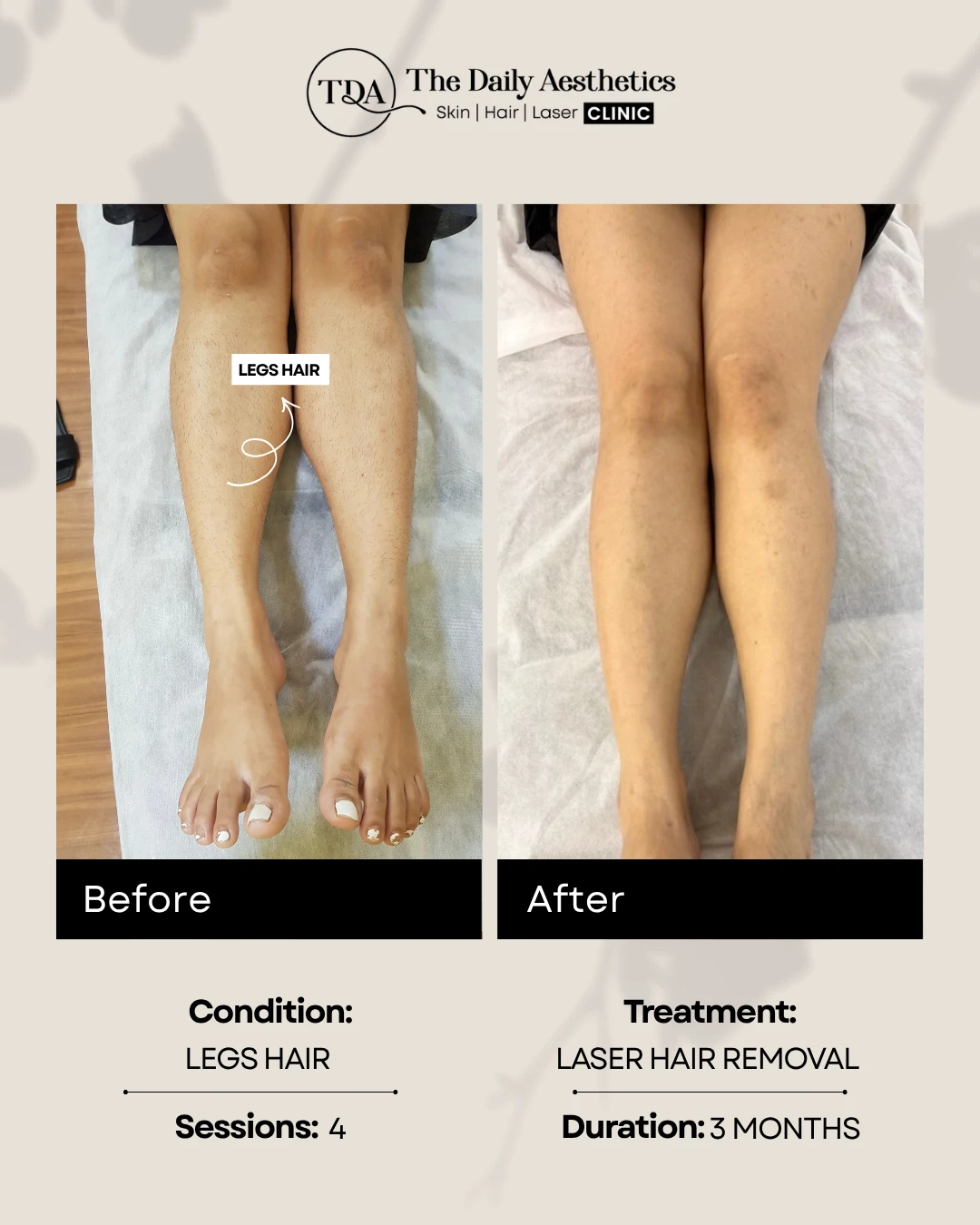 Legs Hair (Laser Hair Removal Treatment)