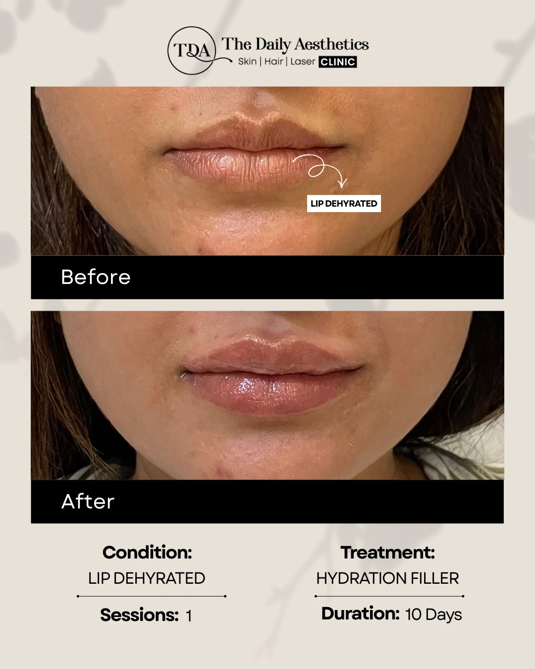Lip Dehydration (Hydration Filler Treatment)