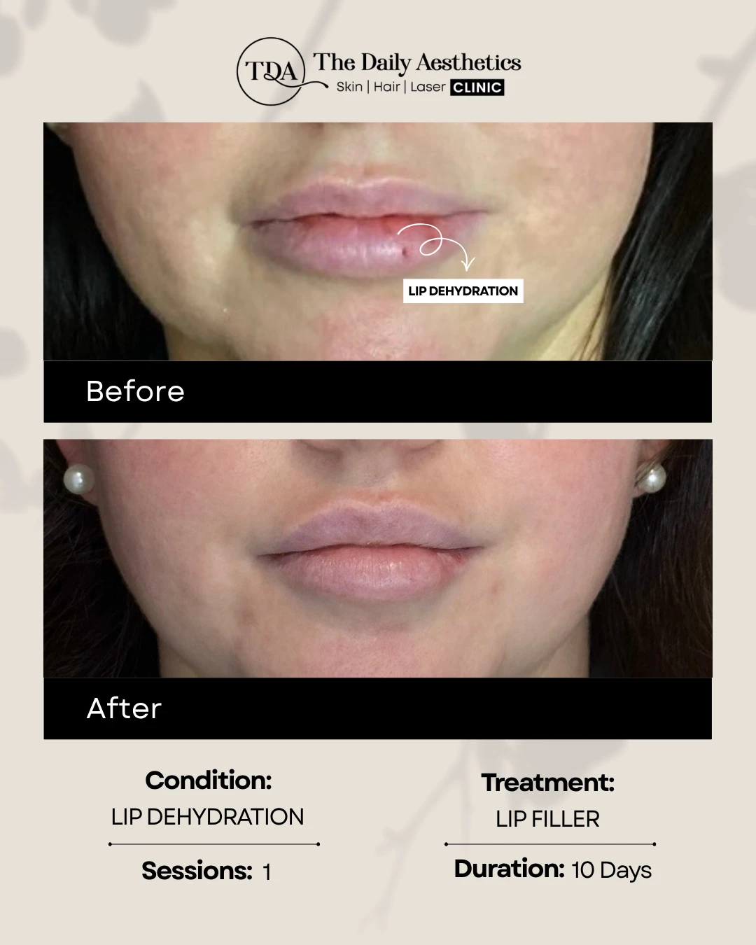 Lip Dehydration (Lip Filler Treatment) (2)