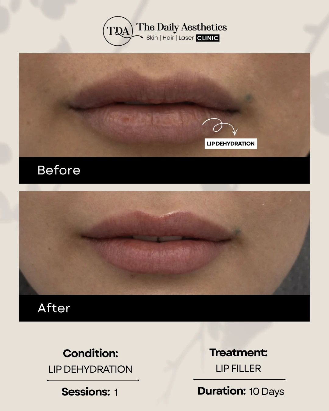 Lip Dehydration (Lip Filler Treatment)
