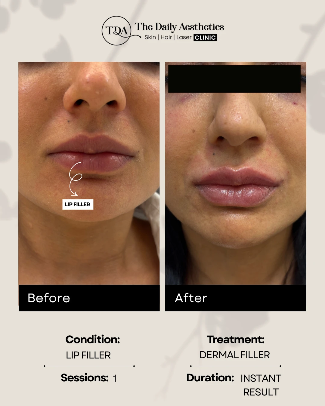 Lip Filler (Dermal Filler)