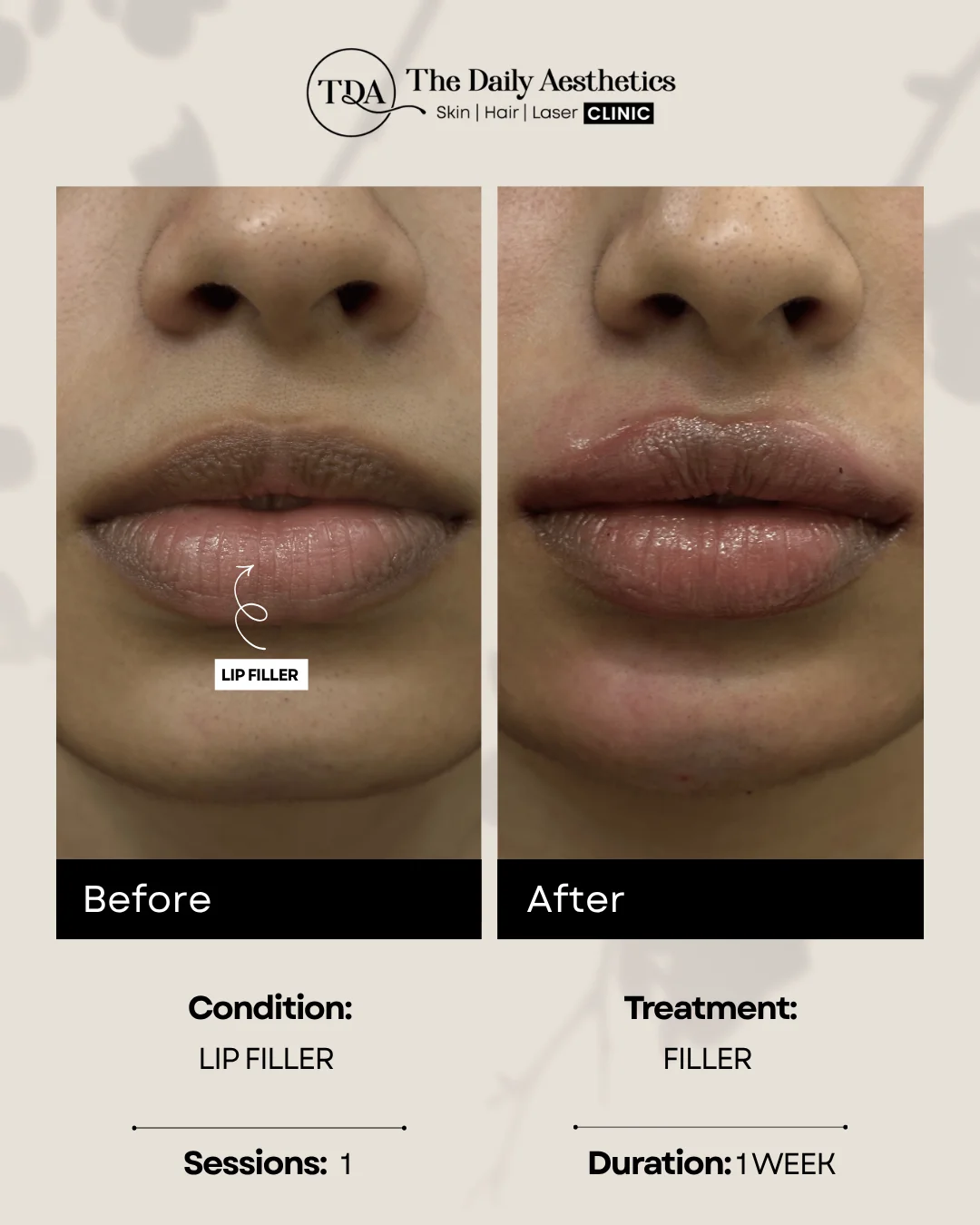 Lip Filler (Filler Treatment)