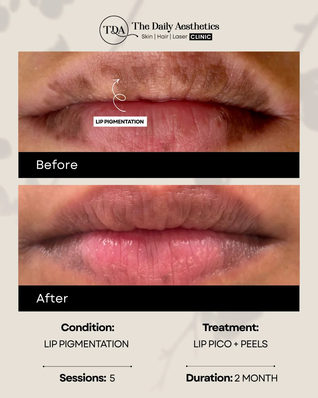 Lip Pigmentation (Lip Pico + Peels Treatment)
