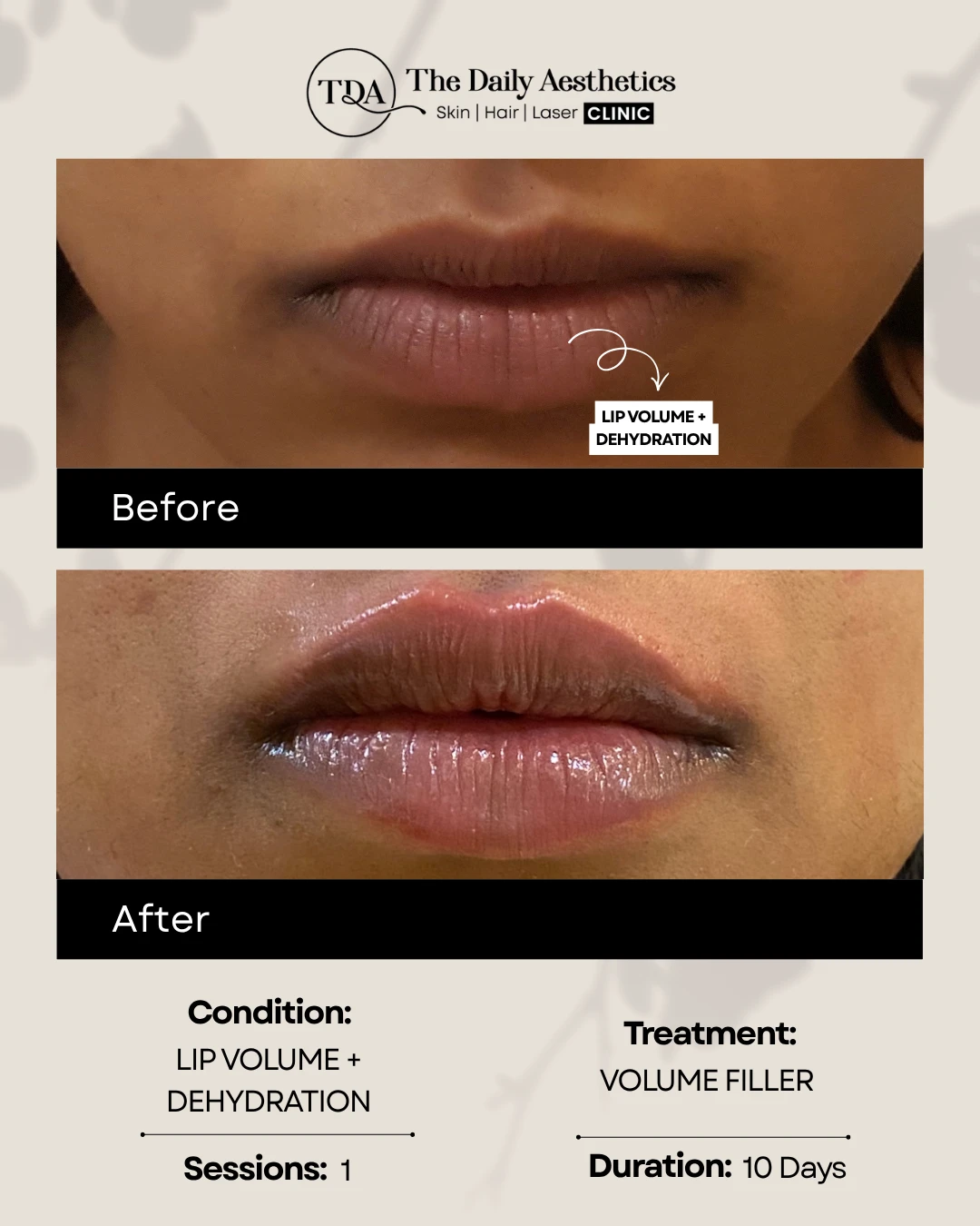 Lip Volume + Dehydration (Volume Filler Treatment)
