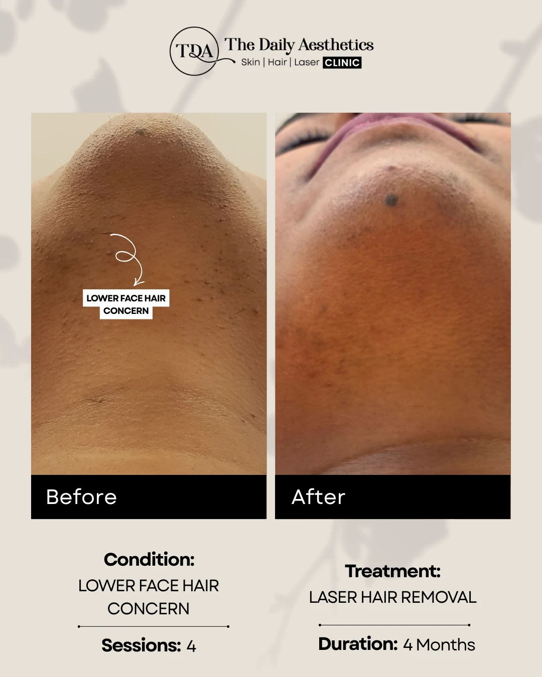 Lower Face Hair Concern (Laser Hair Removal Treatment) (2)