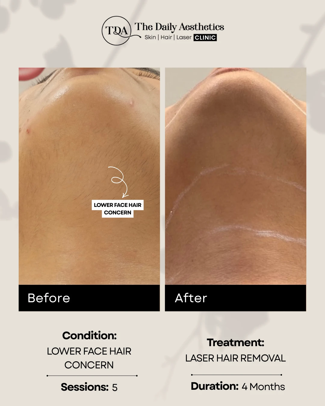 Lower Face Hair Concern (Laser Hair Removal Treatment)