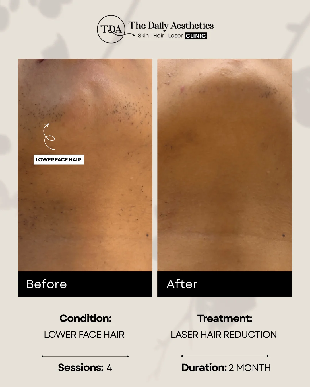 Lower Face Hair (Laser Hair Reducation Treatment)