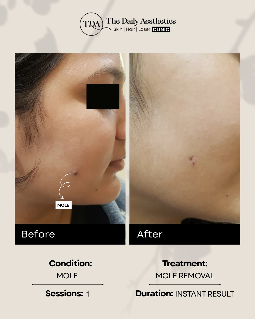 Mole (Mole Removal Treatment)