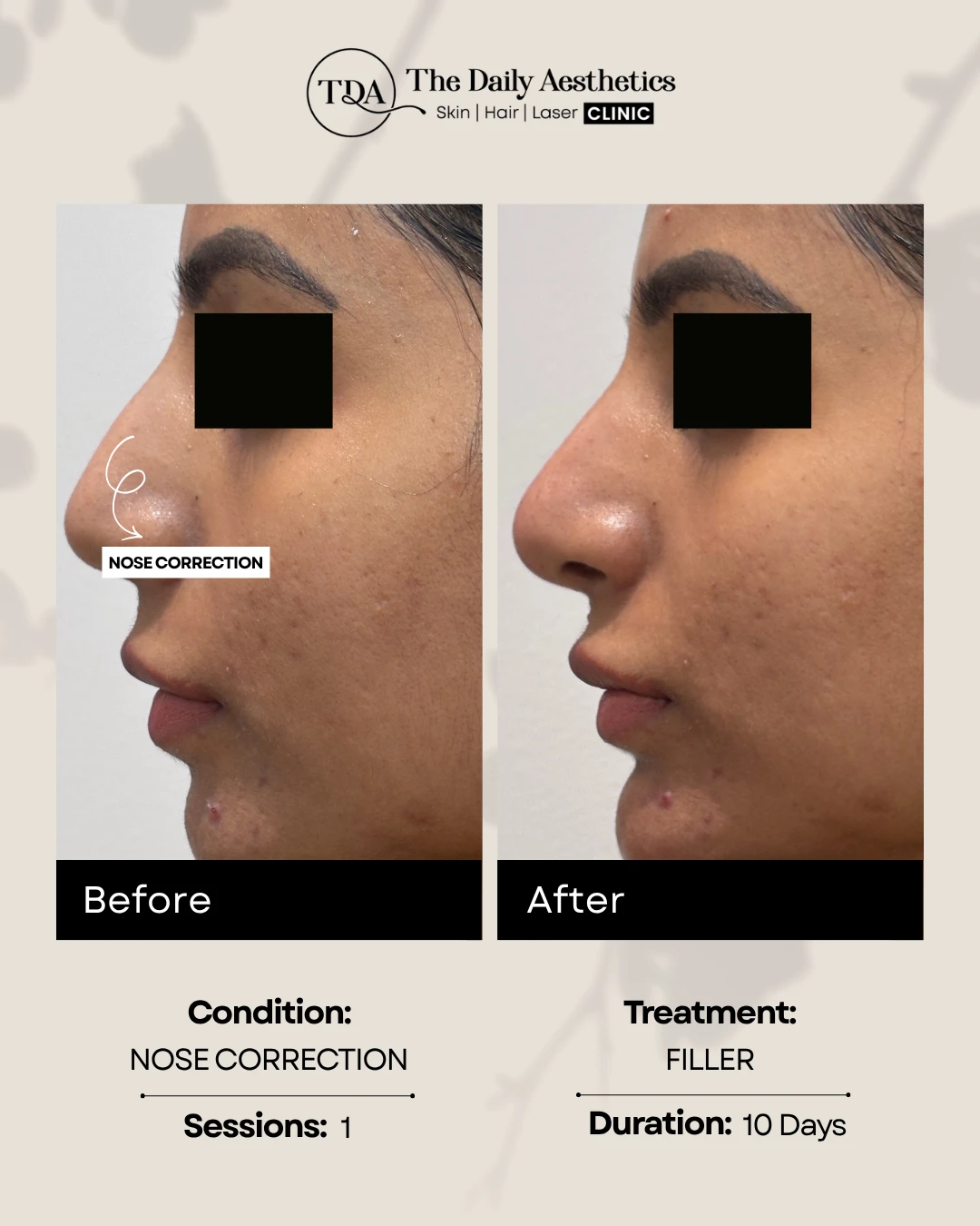 Nose Correction (Filler Treatment)