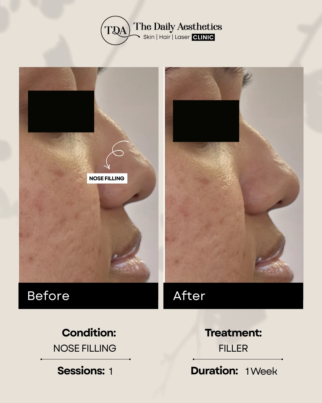 Nose Filling (Filler) (2)