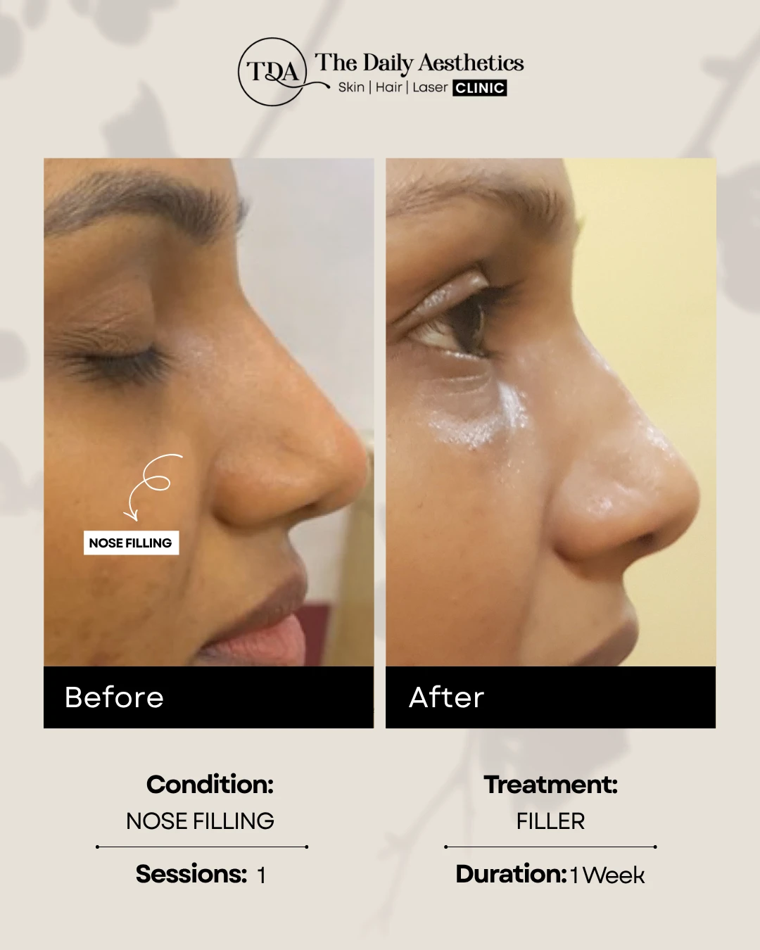 Nose Filling (Filler Treatment) (2)