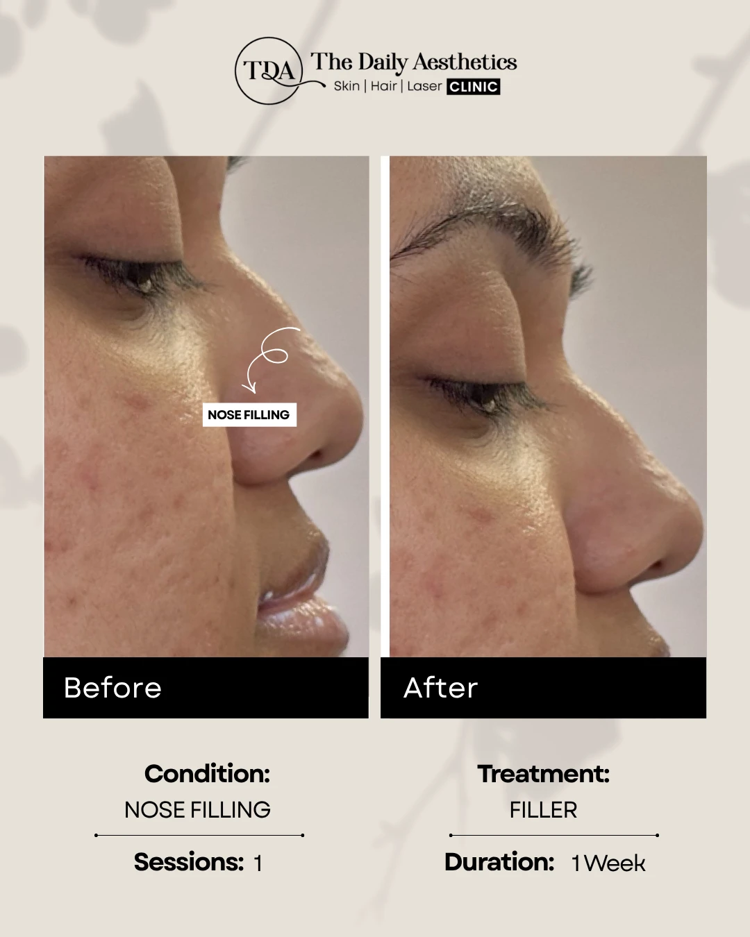 Nose Filling (Filler Treatment)