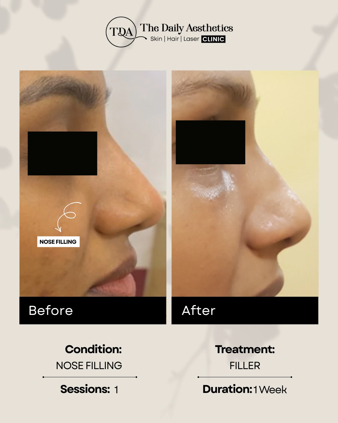Nose filling (Filler)