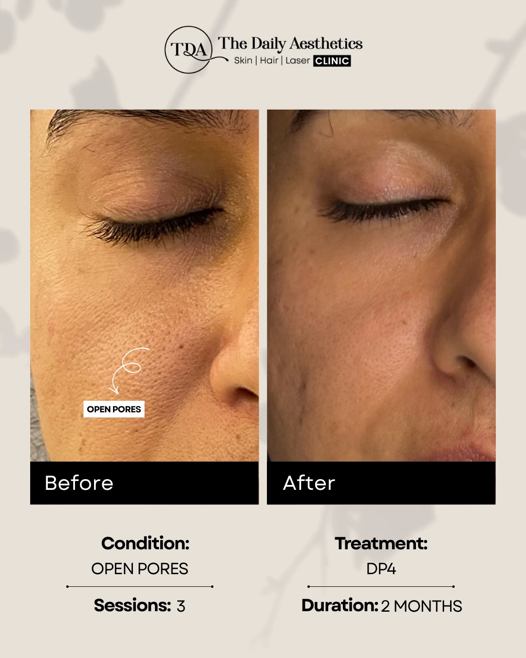 Open Pores (DP4 Treatment)
