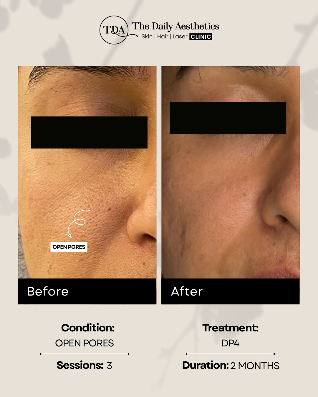 Open Pores (DP4)