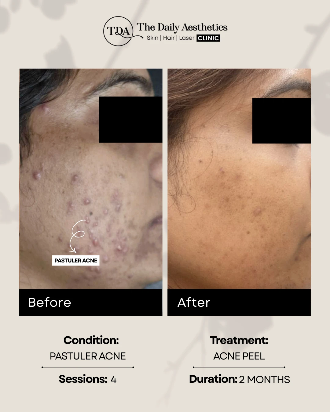 Pastuler Acne (Acne Peel Treatment) (2)