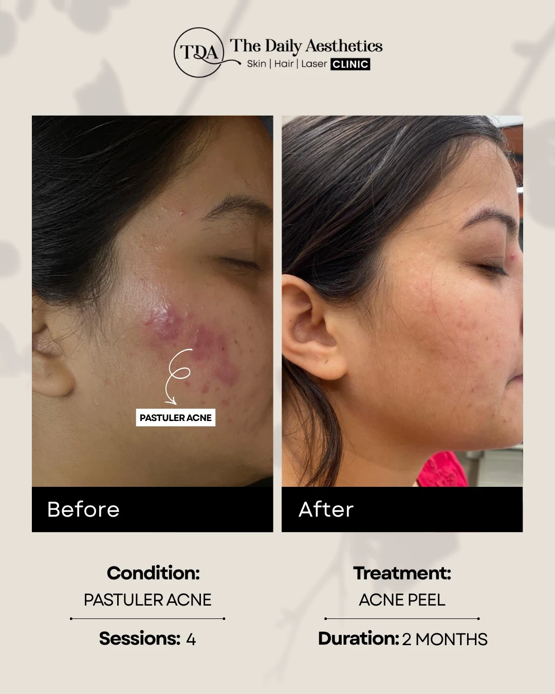 Pastuler Acne (Acne Peel Treatment) (3)