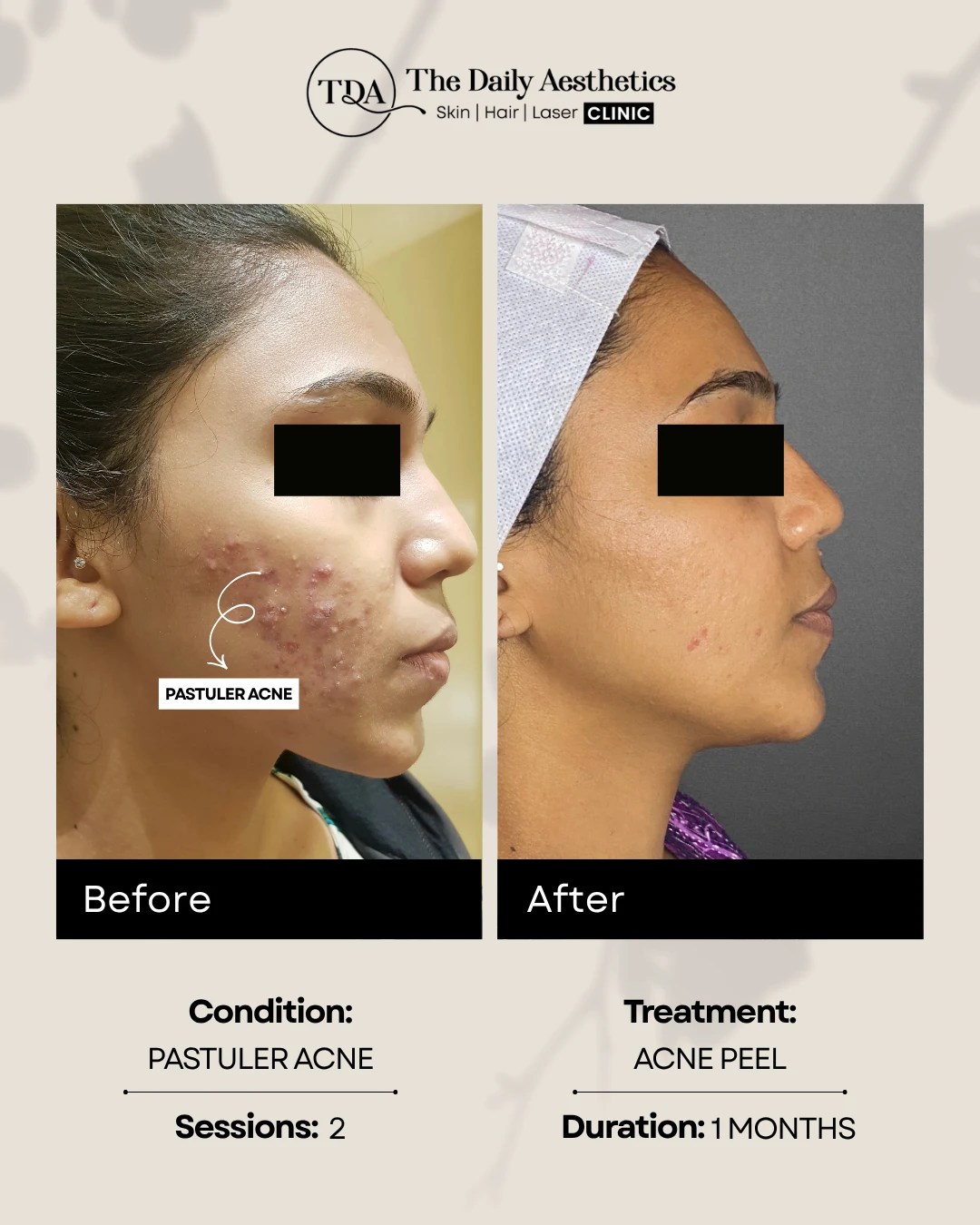 Pastuler Acne (Acne Peel Treatment)