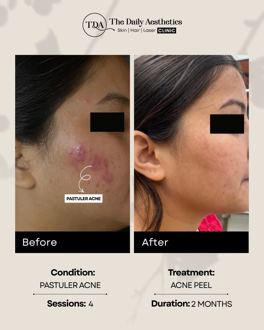 Pastuler Acne (Acne Peel)
