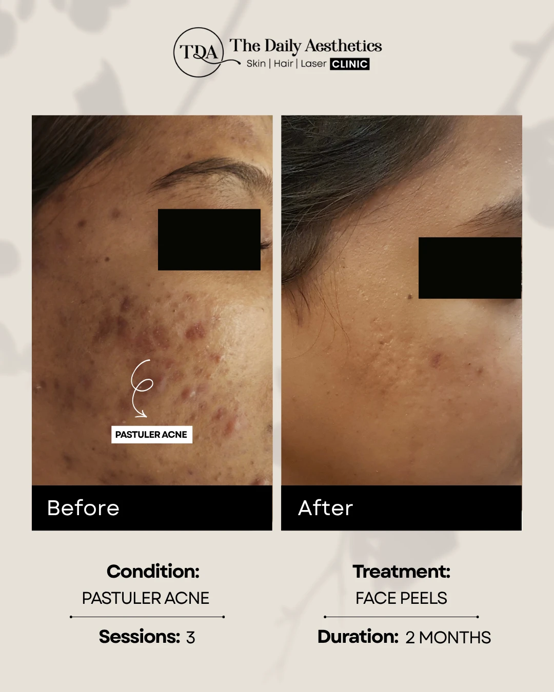 Pastuler Acne (Face Peels)