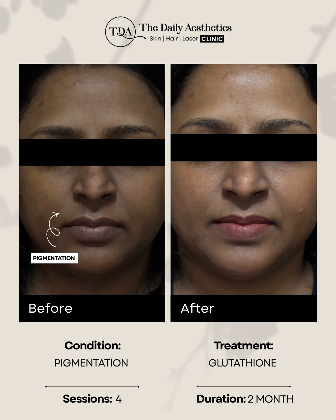 Pigmentataion (Glutathione Treatment)