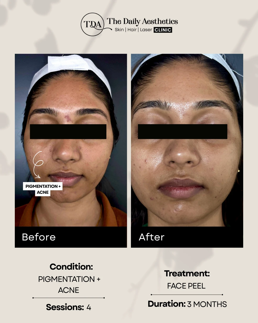 Pigmentation + Acne (Face Peel Treatment)