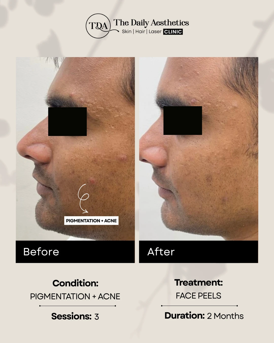 Pigmentation + Acne (Face Peels Treatment)