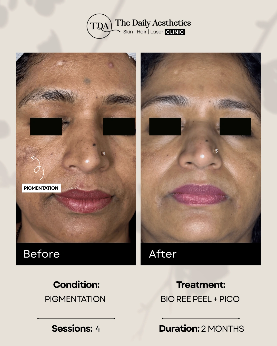 Pigmentation (Bio Ree Peel + Pico Treatment)