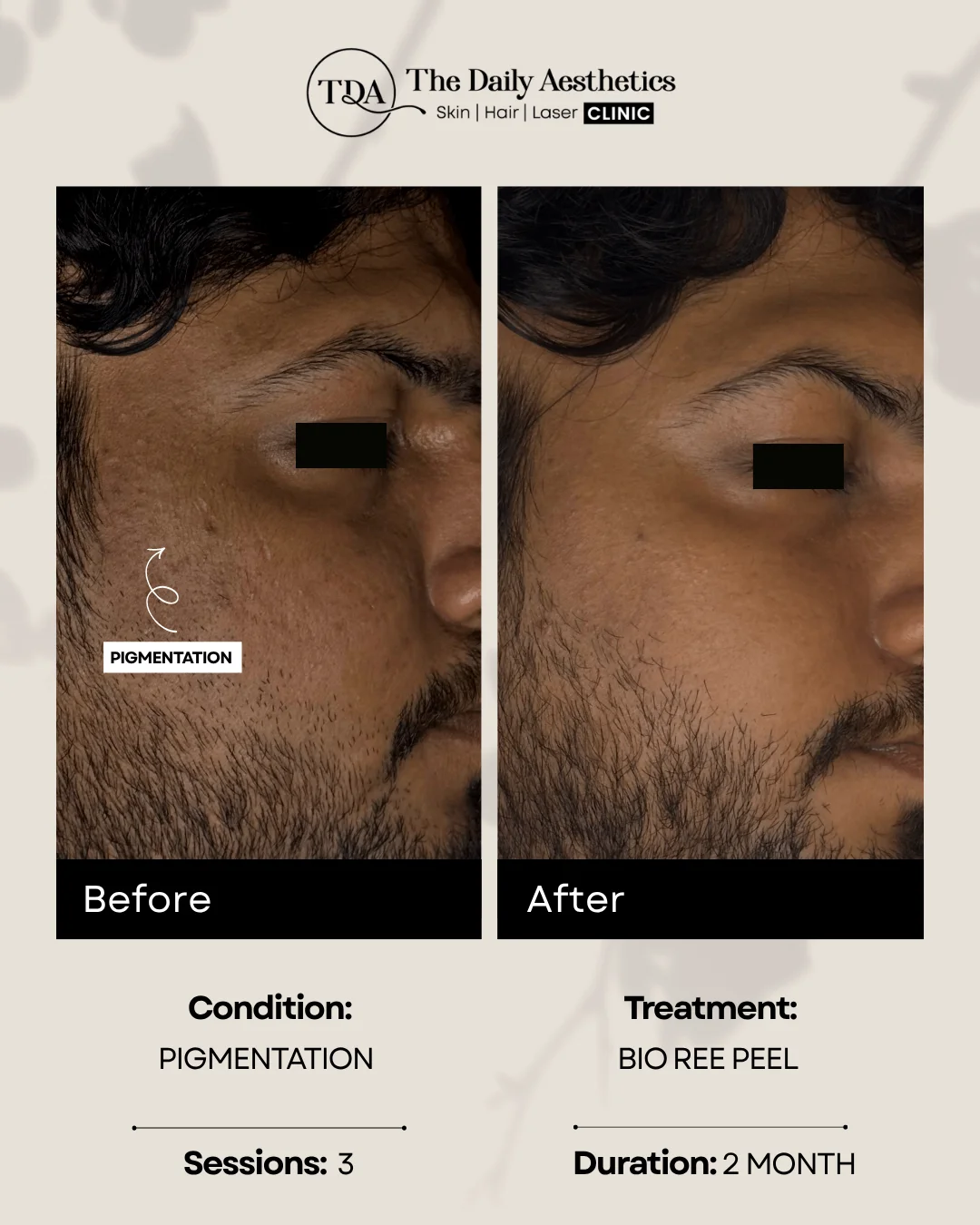 Pigmentation (Bio Ree Peel Treatment)