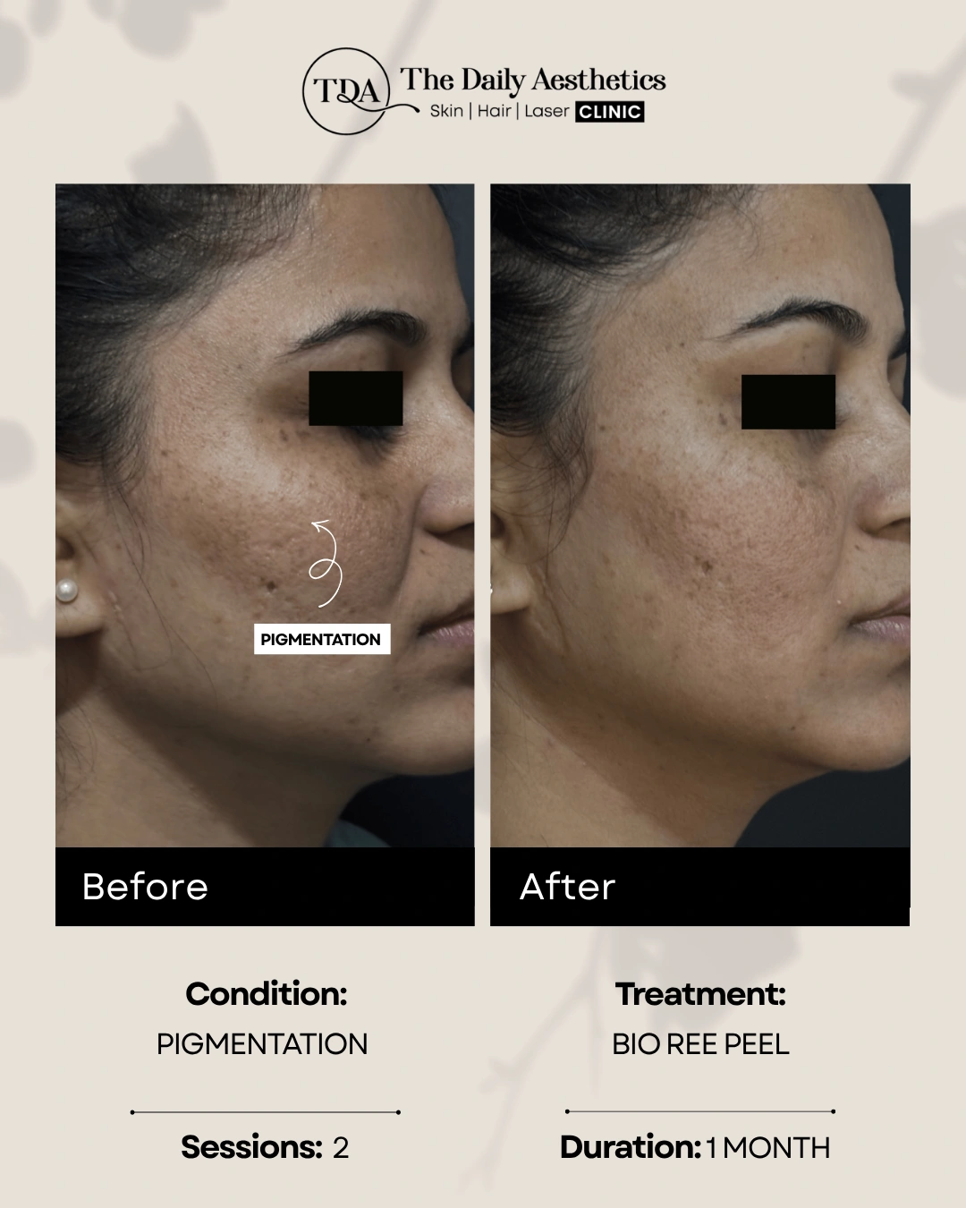Pigmentation (Bio Ree Peel Treatment) (2)