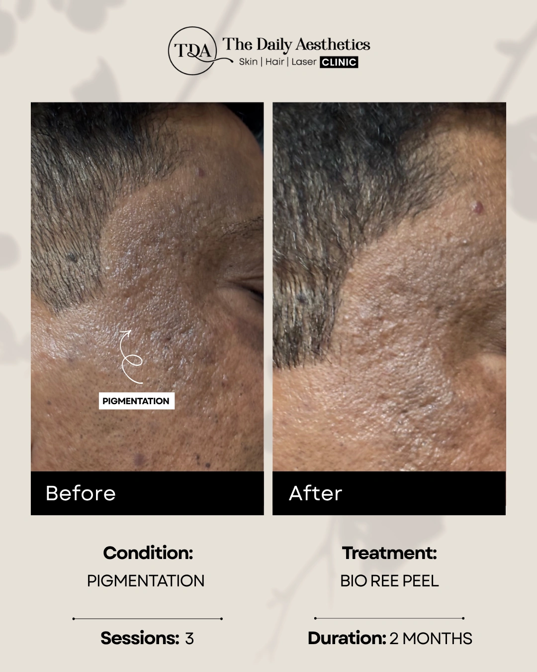 Pigmentation (Bio Ree Peel Treatment)