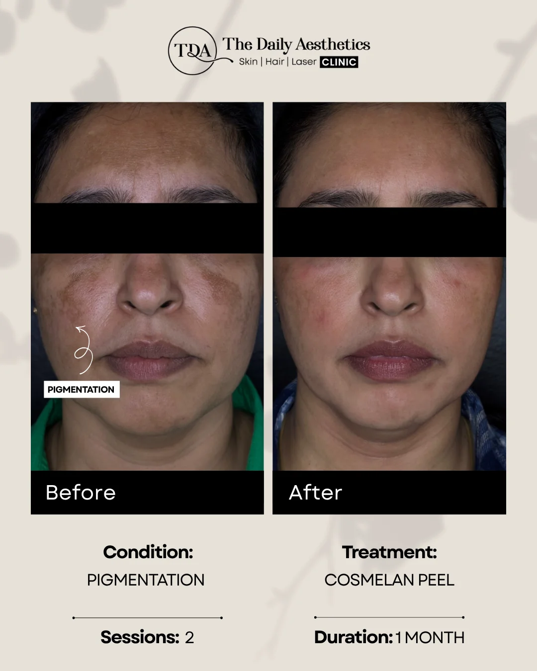 Pigmentation (Cosmelan Peel Treatment)