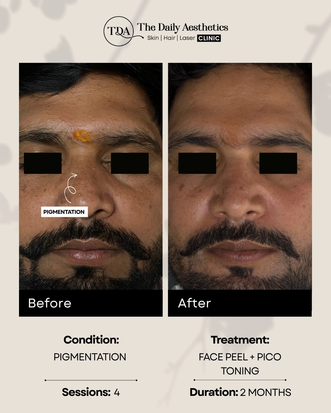 Pigmentation (Face Peel + Pico Toning Treatment)
